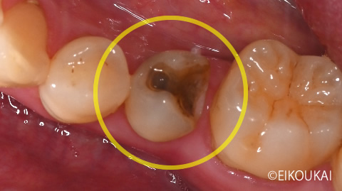 術前:セラミッククラウン