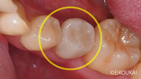 術後:セラミッククラウン