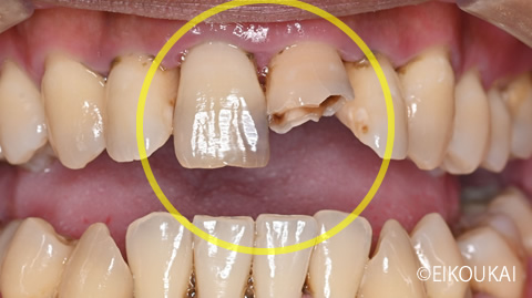 術前：オールセラミッククラウンプレミアム
