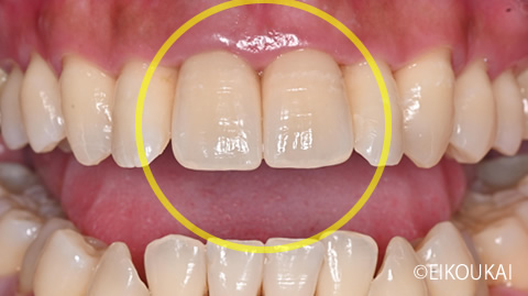 術後：オールセラミッククラウンプレミアム