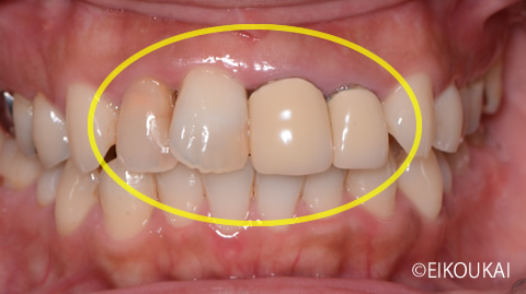 術前：前歯ジルコニアクラウン