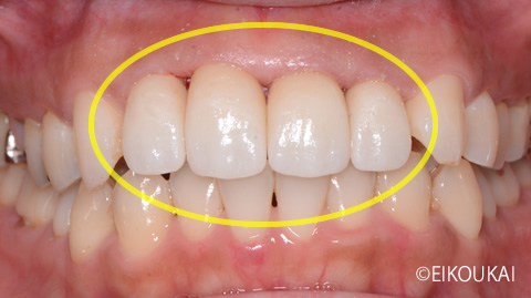 術後：前歯ジルコニアクラウン