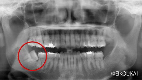 術前:親知らず抜歯