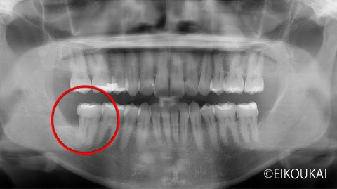 術後:親知らず抜歯