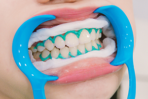 歯茎の保護